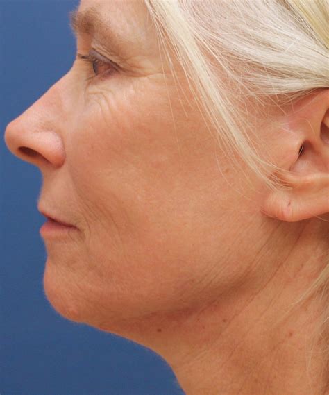 Fractional Laser Resurfacing Case 8 Cascade Facial Surgery And