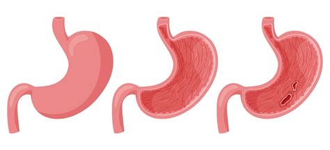 Peptic Ulcer In Human Stomach 22947113 Vector Art At Vecteezy