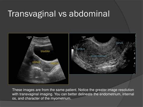 Ppt Transvaginal Ultrasound Powerpoint Presentation Free Download