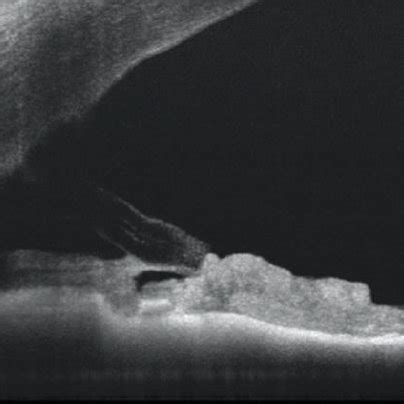 XEN Stent Placement A And Anterior Segment OCT B Showing