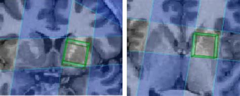 Voxel Placement T Structural Image Of One Representative Participant