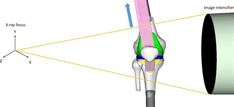 Patellar Resurfacing Has Minimal Impact On In Vitro Tibiofemoral