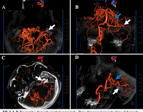 Figure 3 From Pial Brainstem Artery Arteriovenous Malformation With