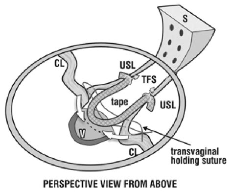 Posterior Tfs Sling Perspective View From Above The Tfs Anchors