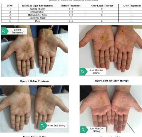 Leech Therapy Before And After