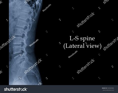 Стоковая фотография 594500984 Film Xray Lumbar Spine Ls Spine Shutterstock