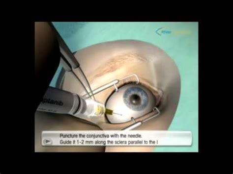 Diabetic Retinopathy Intravit Injection Video 3 YouTube