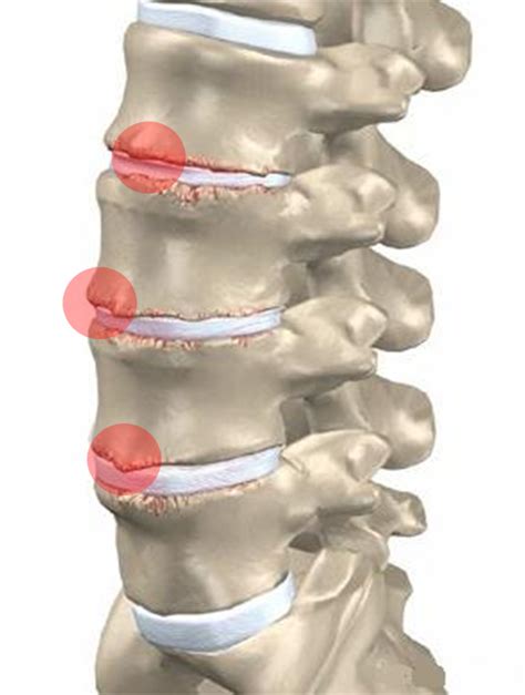 Osteopatia Sa De Bicos De Papagaio O Que