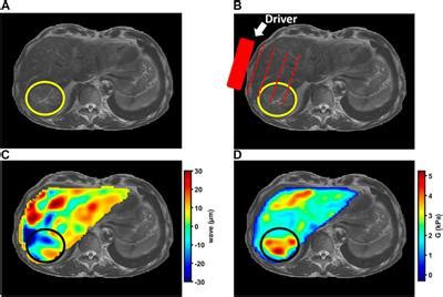 Frontiers Magnetic Resonance Elastography Of Malignant Tumors