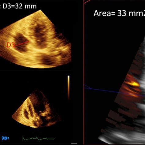 Two Dimensional Color Transthoracic Echocardiogram Showing Left