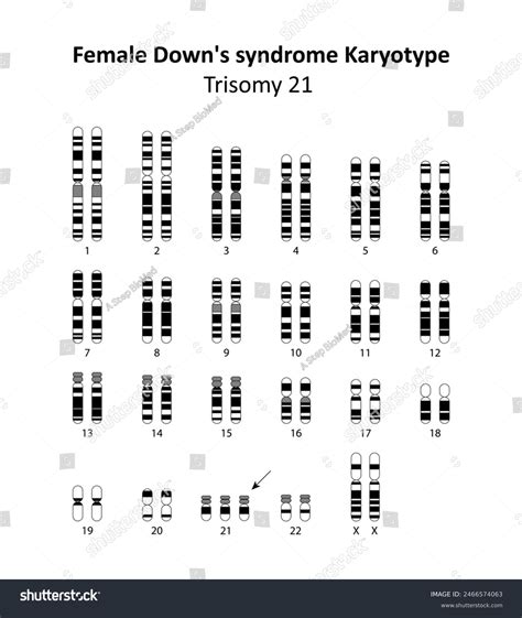 Female Downs Syndrome Trisomy 21 Human Royalty Free Stock Vector 2466574063