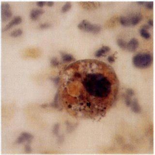 Brownish Staining Cytoplasmic Inclusions In Alveolar Macrophage