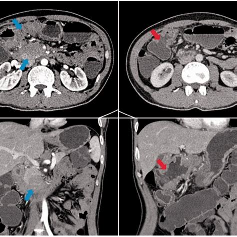 Contrast Computed Tomography Scan Of The Abdomen Transverse And