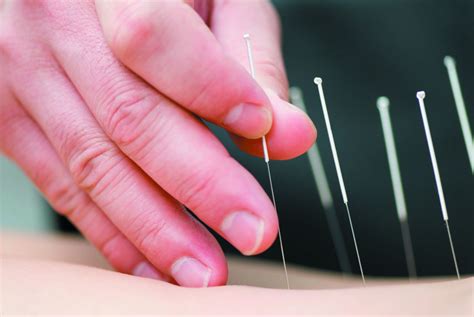 Acupuncture Cure Akupunktur Di Surabaya