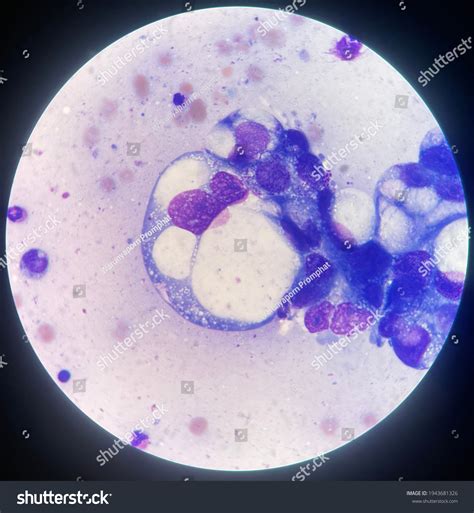 Ascitic Fluid Peritoneal Fluid Analysis Wrights Stock Illustration ...