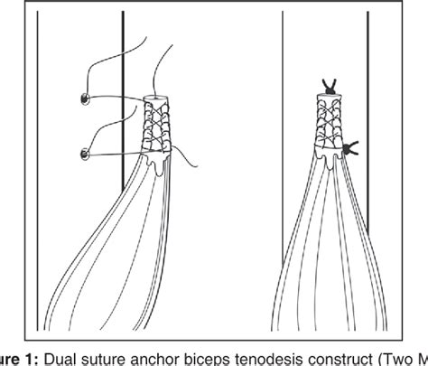 Figure 1 from Complications after subpectoral biceps tenodesis using a ...