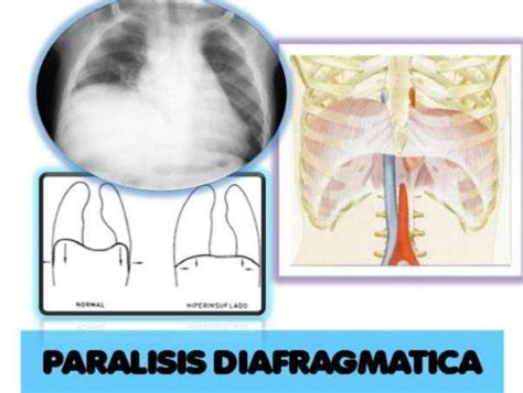 Qué es el diafragma Anatomía importancia y funciones Demedicina