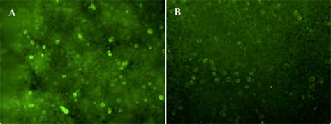 Dppx Antibody Mediated Autoimmune Encephalitis：the First Case With Breast Cancer And Review Of