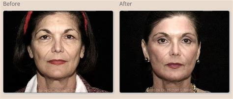 Blepharoplasty Complications Are Rare Good Plastic Surgeon