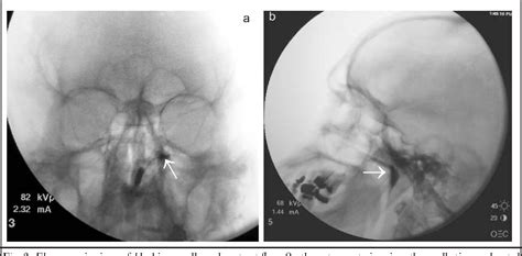 Figure 1 From A Novel Approach To Transnasal Sphenopalatine Ganglion Injection Semantic Scholar