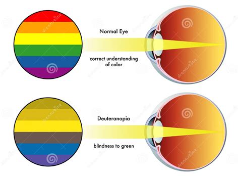 Mengenal Jenis Jenis Buta Warna Ai Care