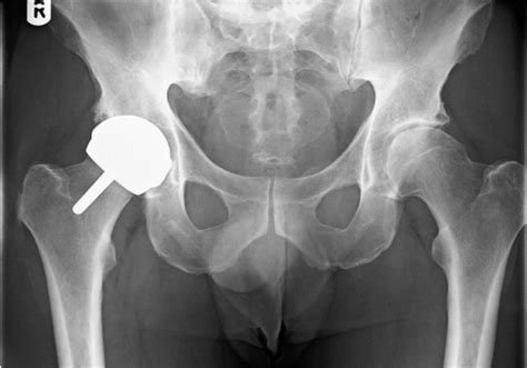 Resurfacing Hip Arthroplasty Invicta Orthopedics