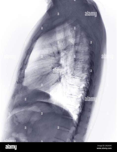 Chest X Ray Or X Ray Image Of Human Lung Lateral View With Full