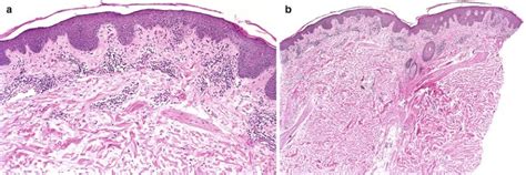 Psoriasiform Dermatoses Springerlink