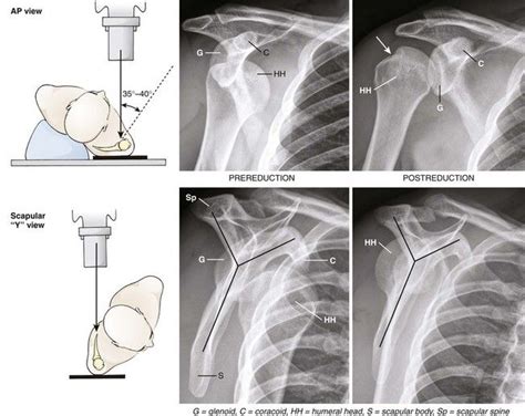 Y VIEW SHOULDER POSITIONING XR | Radiology student, Medical radiography ...