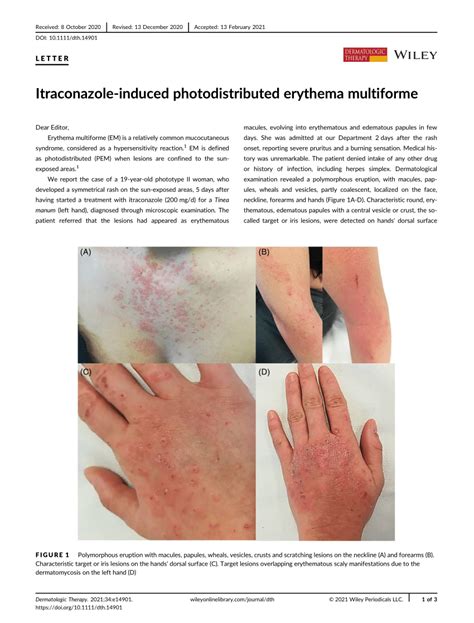 Itraconazoleinduced Photodistributed Erythema Multiforme Request PDF