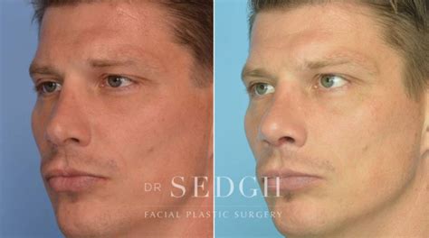 Crooked Nose Surgery Before After Photos Dr Sedgh