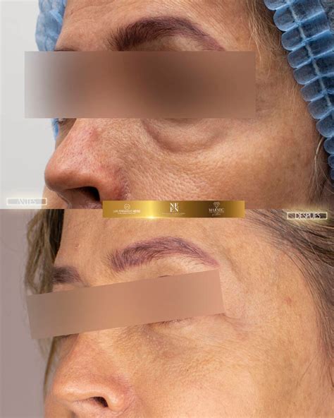 Blefaroplastia en Bogotá Dra Nicole Echeverry Cirujana Plástica Bogotá