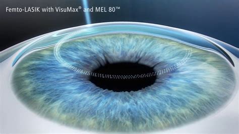 Lasik Femtoseconde La Chirurgie Des Yeux Au Laser Youtube