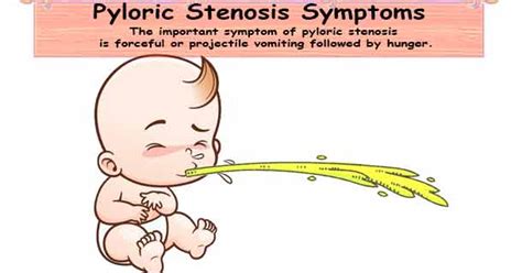 Pyloric Stenosis Symptoms | Signs Symptoms of Pyloric Stenosis