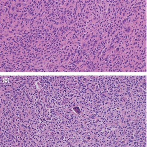 Hande Stain 200× Of Nodular Form Shows Giant Cells And Download Scientific Diagram