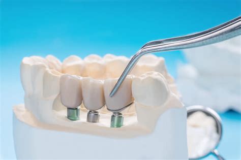 Implantes dentales tipos y clasificación