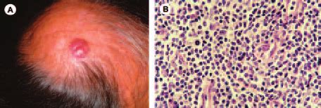 Primary Cutaneous Cd Small Medium Sized Pleomorphic T Cell