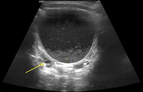 Ultraschall Zur Diagnostik Der Akuten Harnwegsinfektion Bei Kindern