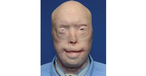 Firefighter Suffers Third Degree Burns This Is Him 7 Years Later