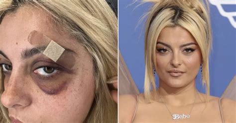 Bebe Rexha Shares Update On Black And Blue Eye After Shocking Stage