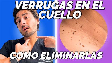 VERRUGAS En El Cuello Como ELIMINARLAS Fibromas Blandos O