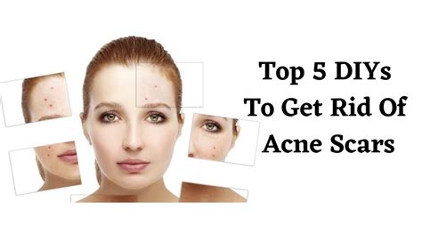 Top 5 Diys To Get Rid Of Acne Scars Intibeauty