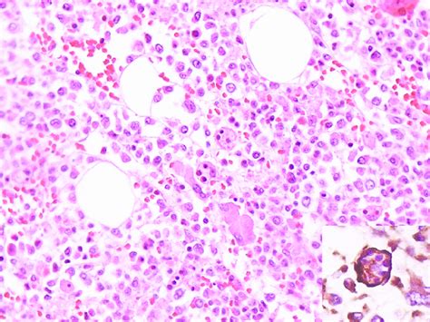 Photomicrography Of The Bone Marrow Showing Emperipolesis H E 40