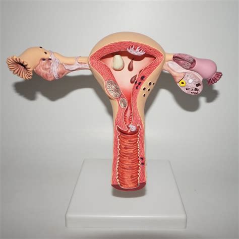 Human Pathological Uterus Ovary Model Anatomical Anatomy Disease