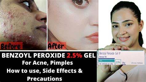 Benzoyl Peroxide Side Effects