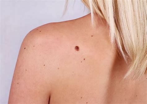 What Is A Seborrheic Keratosis Mona Dermatology