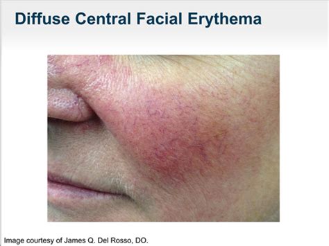 Understanding And Managing The Facial Erythema Of Rosacea Transcript