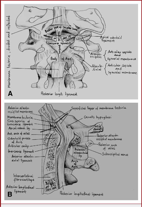 Figure 1 From The Craniovertebral Junction Area And The Role Of The Ligaments And Membranes