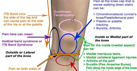 Meniscus Knee Pain Location Chart