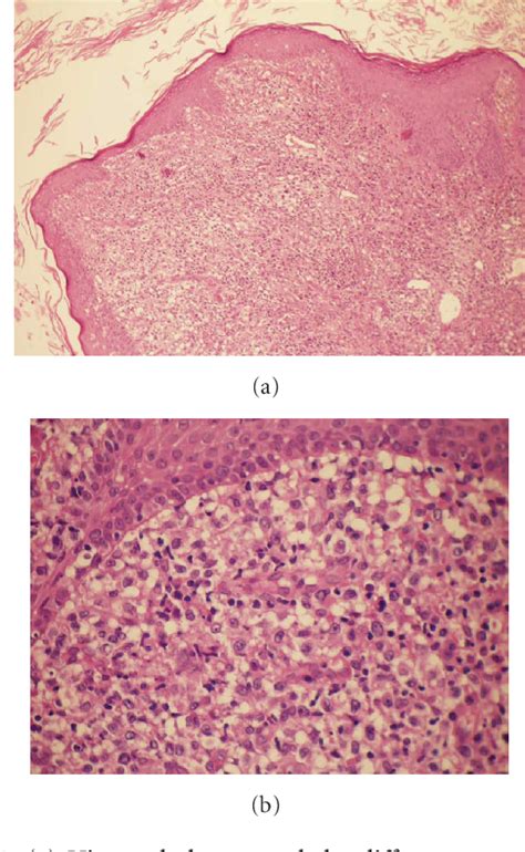 Indeterminate Dendritic Cell Tumor Semantic Scholar